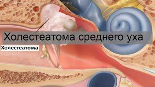 Холестеатома среднего уха