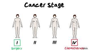 What is Cancer Stage?