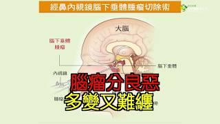 腦瘤分良惡 多變又難纏