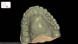 Creating the Perfect Denture Monoblock Design