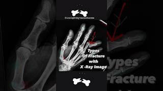 Types of Fracture with X-ray images #shorts #shortvideo #norcet #nursingofficeraiims #neet #mbbs #rn