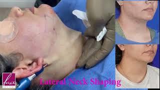 Lateral Neck Shaping - Double Chin Liposuction