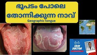 white spots on tongue Malayalam/geographic tongue/cracked tongue/oral candidiasis /orallichen plan