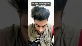 Best Hair Transplant Results in 12 Months #hairtransplantresults #hairtransplant #hairloss