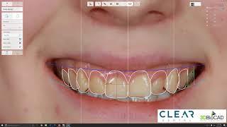 Mock-up Part 1 - Digital Smile Design 3Shape Trios