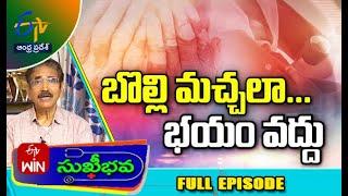 About Vitiligo | Sukhibhava | 25th June 2023 | Full Episode | ETV Andhra Pradesh