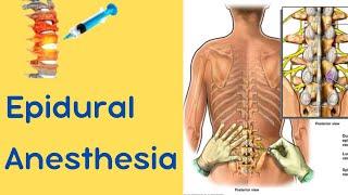 Epidural Anesthesia
