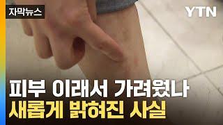 [자막뉴스] '원인 불명' 가려움증...수수께끼 퍼즐 풀렸다 / YTN