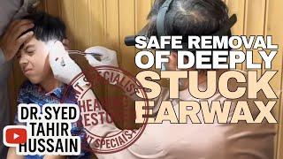 Safe Removal of Deeply Stuck Earwax Causing Hearing Loss and Pain