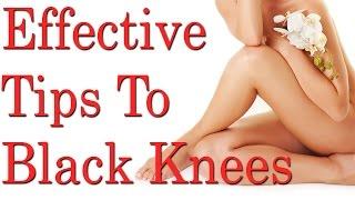 15 Effective Tips To Get Rid Of Black Knees And Elbow