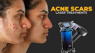 Laser Treatment for Acne Scars at Kyra Aesthetic Clinic | Dr. Vikas Gawri | Ludhiana