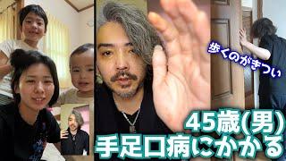 45歳が手足口病にかかったので現状をお話しします！【癒しの映像付き】