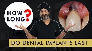 How Long Do Dental Implants Last?