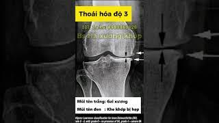 Hình Ảnh X-quang Các Giai Đoạn Thoái Hoá Khớp Gối