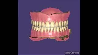 Full Mouth Denture Case #exocad