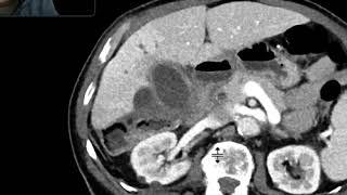 Perforated cholecystitis