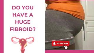 Do you have a Huge Fibroid? What to do