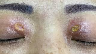 眼瞼黃斑瘤汽化雷射清除手術 美麗新城診所莊禮謙醫師 Xanthelasma, Eyelids, CO2 laser, Dr George(Homelander?)