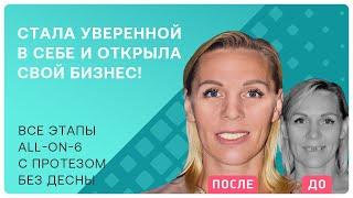 Все зубы на 6 имплантах и протез без десны: этапы цифровой имплантации