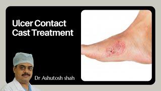 All About Total Contact Cast Treatment, Benefit, and Procedure at Surat Diabetic Foot Care Clinic
