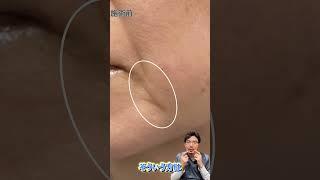 【Dr.菅原症例解説!!】マリオネットラインヒアルロン酸注入解説!!#junclinic #菅原順 ＃ヒアルロン酸