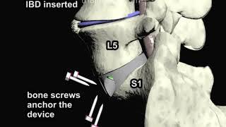 Anterior Lumbar Interbody Fusion (ALIF Part 3) Animation by Cal Shipley, M.D.