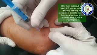 Golfer's Elbow | Epicondylalgia medial | Medial Epicondylalgia, local Steroid shot | Adamya Hosp Vid