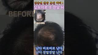 또 한달 뒤! #바로한의원 #정종열원장 #탈모치료 진행 과정 대 공개!!  빨리난다  ~ 진짜 난다!!