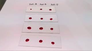 Blood typing(Rh positive) slide agglutination test |MEDICAL LABORATORY SCIENCE