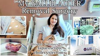 GALLBLADDER GALLSTONES REMOVAL SURGERY LAPAROSCOPIC CHOLECYSTECTOMY