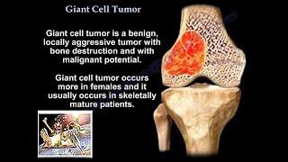 Giant Cell Tumor - Everything You Need To Know - Dr. Nabil Ebraheim