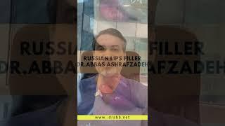 Russian Lip Filler By Dr.abbas Ashrafzadeh