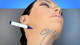 Animation of the MyEllevate® Procedure