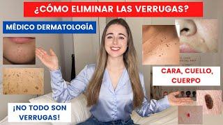 MÉDICO EXPLICA CÓMO ELIMINAR VERRUGAS EN CARA, CUELLO Y CUERPO: ¿EN CASA? | LO QUE NO SON VERRUGAS