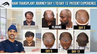 Hair Transplant In Bangalore | Best Clinic Surgeon & Results Of Hair Transplant In Bangalore