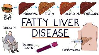 Understanding Non-Alcoholic Fatty Liver Disease