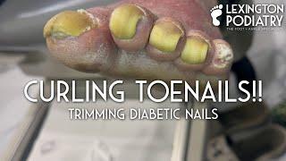 Curling Toenails! Trimming Diabetic Nails