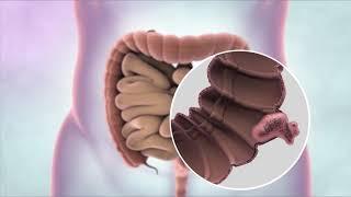 What is bowel cancer? | Cancer Research UK