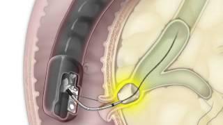 ERCP for Removal of a Stone in the Bile Duct | NEJM
