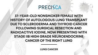 Expert Cancer Panel: 37 y/o w/ Hx lung transplant, now Stage IIB high grade neuroendocrine of lung