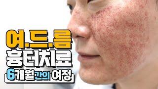 여드름흉터원정대 17탄. 여드름흉터 6개월간의 치료과정 그리고 2번째 사이클 시작