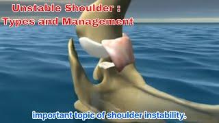 Mastering Shoulder Instability: The Ultimate Guide To Types And Treatment 어깨 불안정성 : 유형과 치료의 모든 것