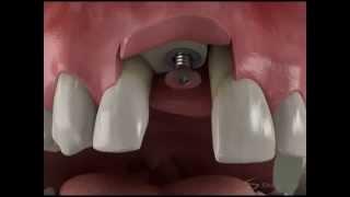 Dentist Tooth Implant Procedure