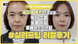 [ 리얼후기 ]  40대실리프팅 / 팔자주름리프팅   /   앞볼처짐리프팅  / 이중턱리프팅 /  실리프팅후기