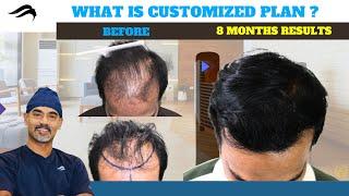 Hair Transplant In Chennai | Best Center Surgeon Results & Cost Of Hair Transplant Of Chennai