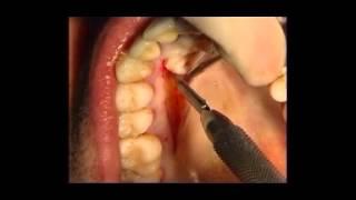 Grafts Techniques - Palatal Linear