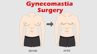 Gynecomastia surgery result