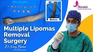 Multiple Lipomas Removal Surgery by Dr. Neeraj Bhaban