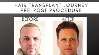 9-Month Hair Transplant INCREDIBLE Transformation