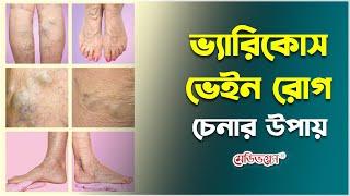 ভ্যারিকোস ভেইন রোগ চেনার উপায় | Dr. AKM Ziaul Haque | Medivoice Health